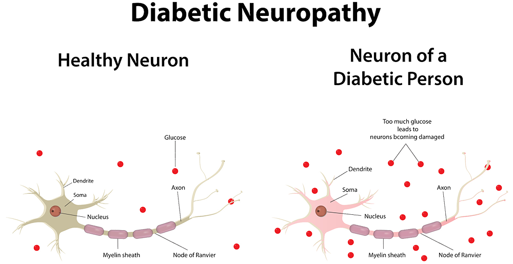 Diabetic Neuropathy - All the facts - GNC Dubai